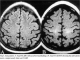 ALS Disease Glossary - Turkey